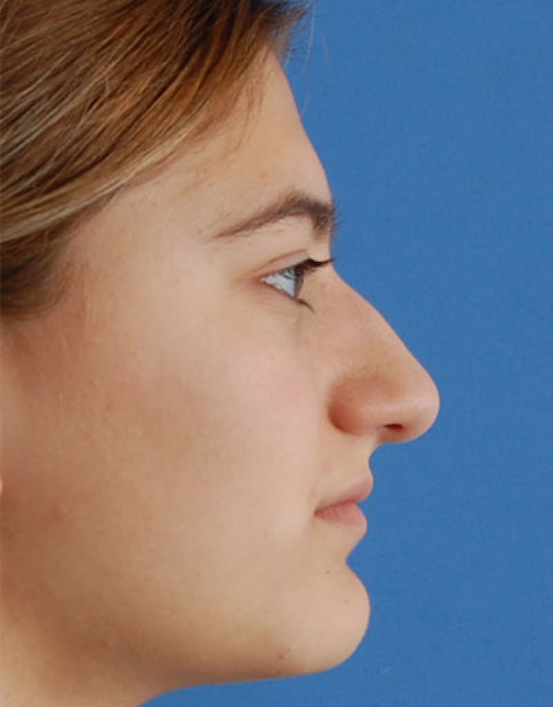 Rhinoplasty Before & After Gallery - Patient 641318 - Image 1