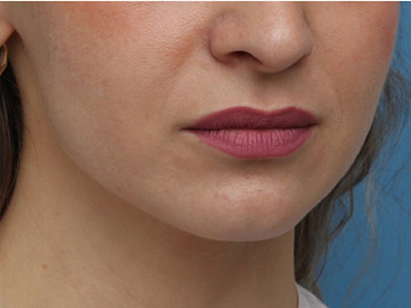 Chin Surgery Before & After Gallery - Patient 144164 - Image 5