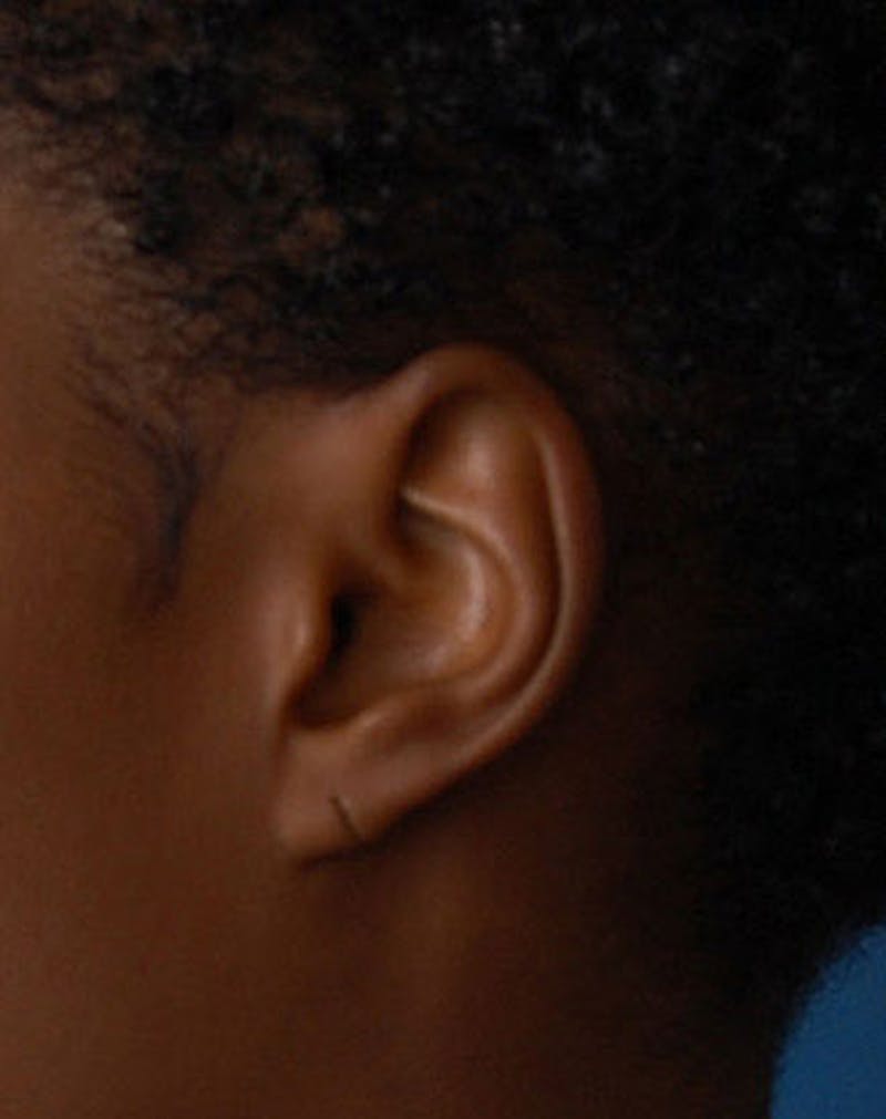 Ear Surgery Before & After Gallery - Patient 226228 - Image 1