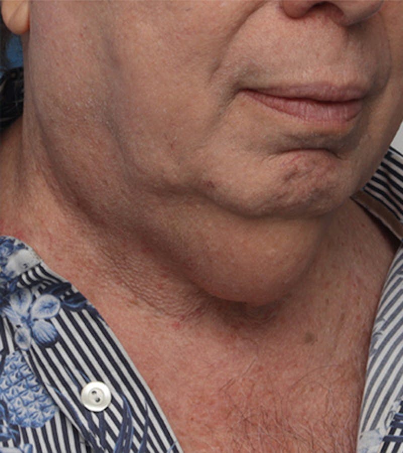 Facelift Before & After Gallery - Patient 324553 - Image 5