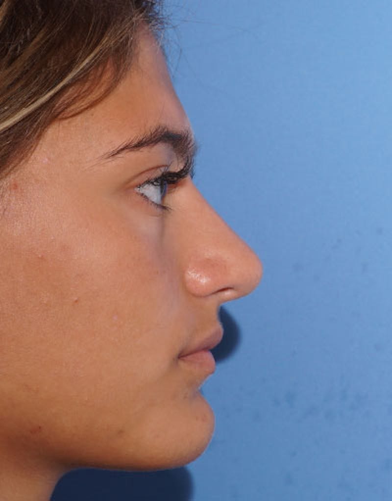 Rhinoplasty Before & After Gallery - Patient 641318 - Image 2