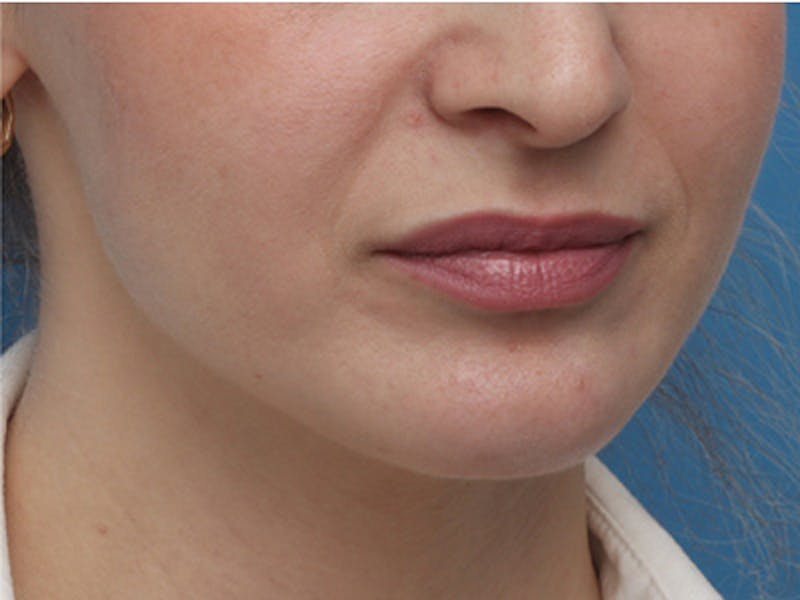Chin Surgery Before & After Gallery - Patient 144164 - Image 6
