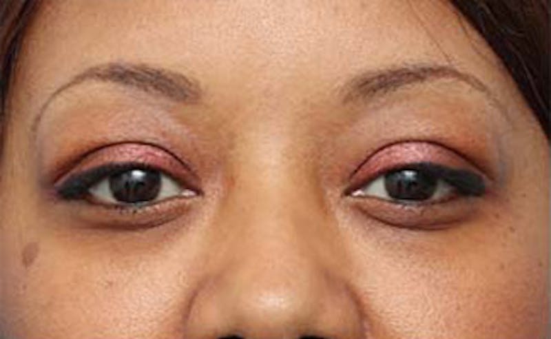 Eyelid Surgery Before & After Gallery - Patient 108834 - Image 1