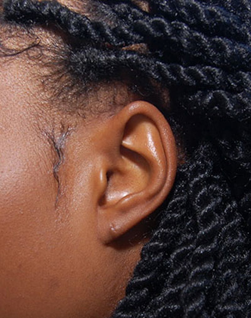 Ear Surgery Before & After Gallery - Patient 226228 - Image 2