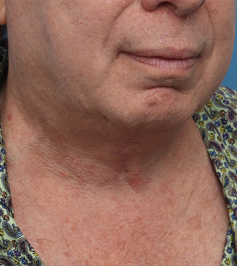 Facelift Before & After Gallery - Patient 324553 - Image 6