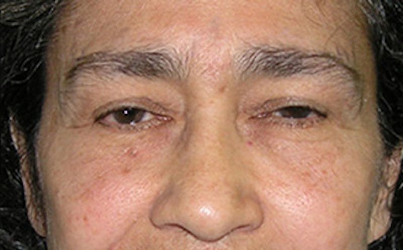 Brow Lift Before & After Gallery - Patient 115111 - Image 1