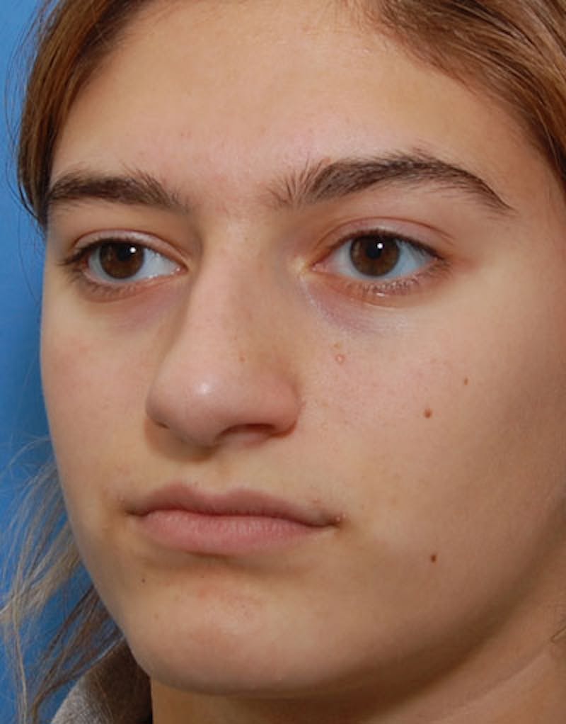 Rhinoplasty Before & After Gallery - Patient 641318 - Image 5