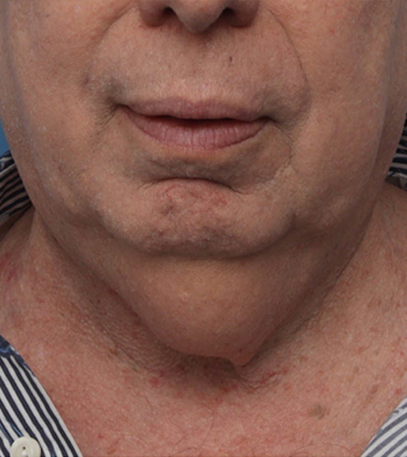 Facelift Before & After Gallery - Patient 324553 - Image 7