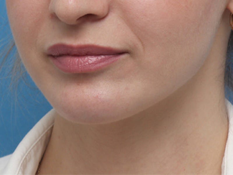 Chin Surgery Before & After Gallery - Patient 144164 - Image 8