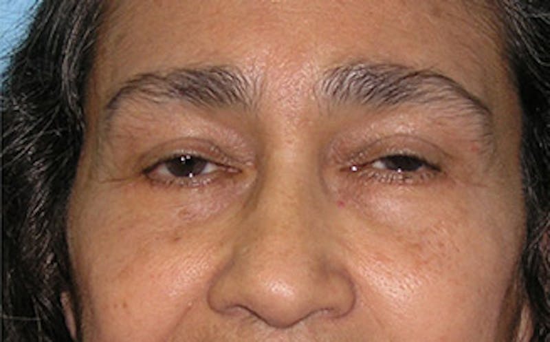 Brow Lift Before & After Gallery - Patient 115111 - Image 2
