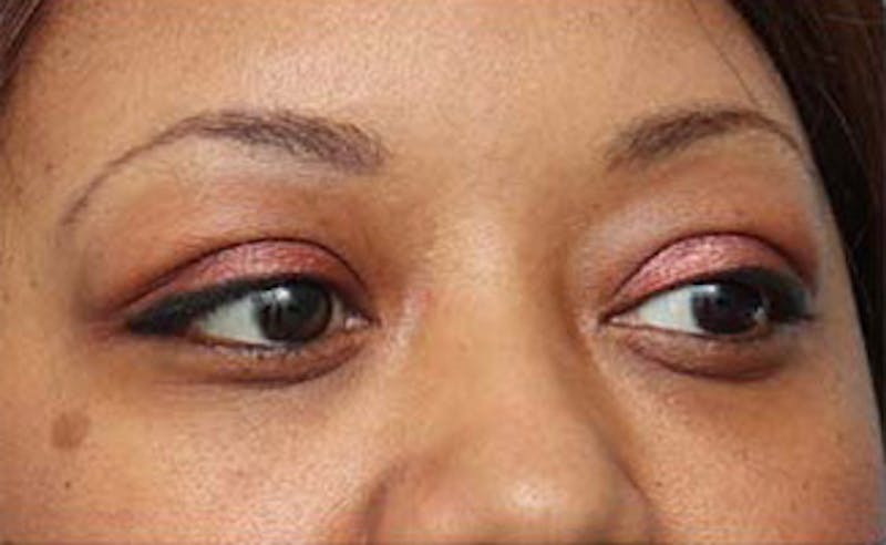 Eyelid Surgery Before & After Gallery - Patient 108834 - Image 3