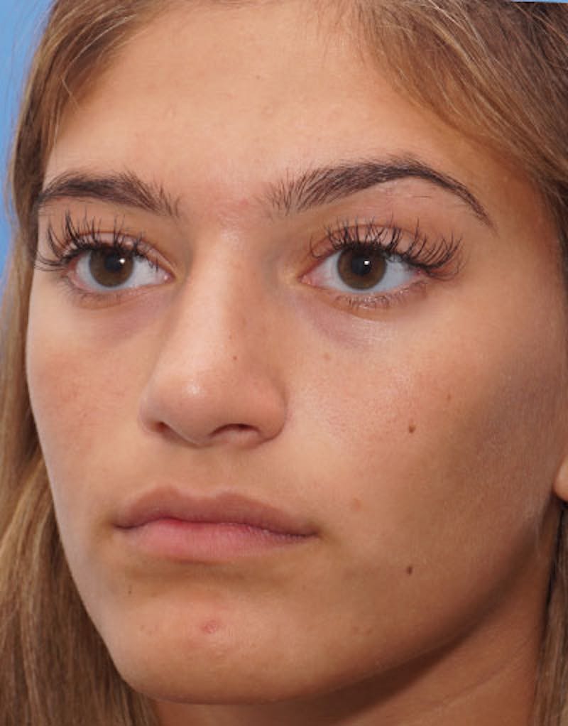 Rhinoplasty Before & After Gallery - Patient 641318 - Image 6