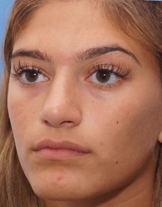 Rhinoplasty Before & After Gallery - Patient 638251 - Image 6