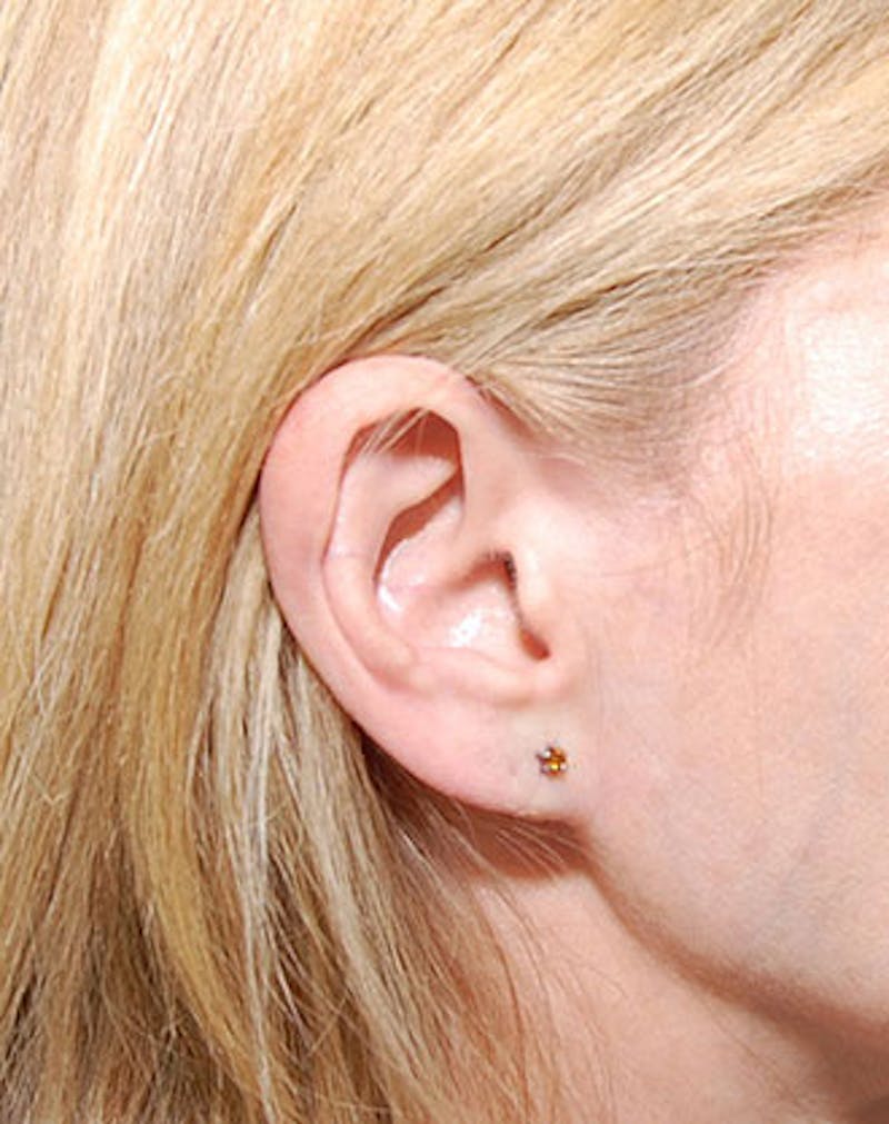 Ear Surgery Before & After Gallery - Patient 102330 - Image 2