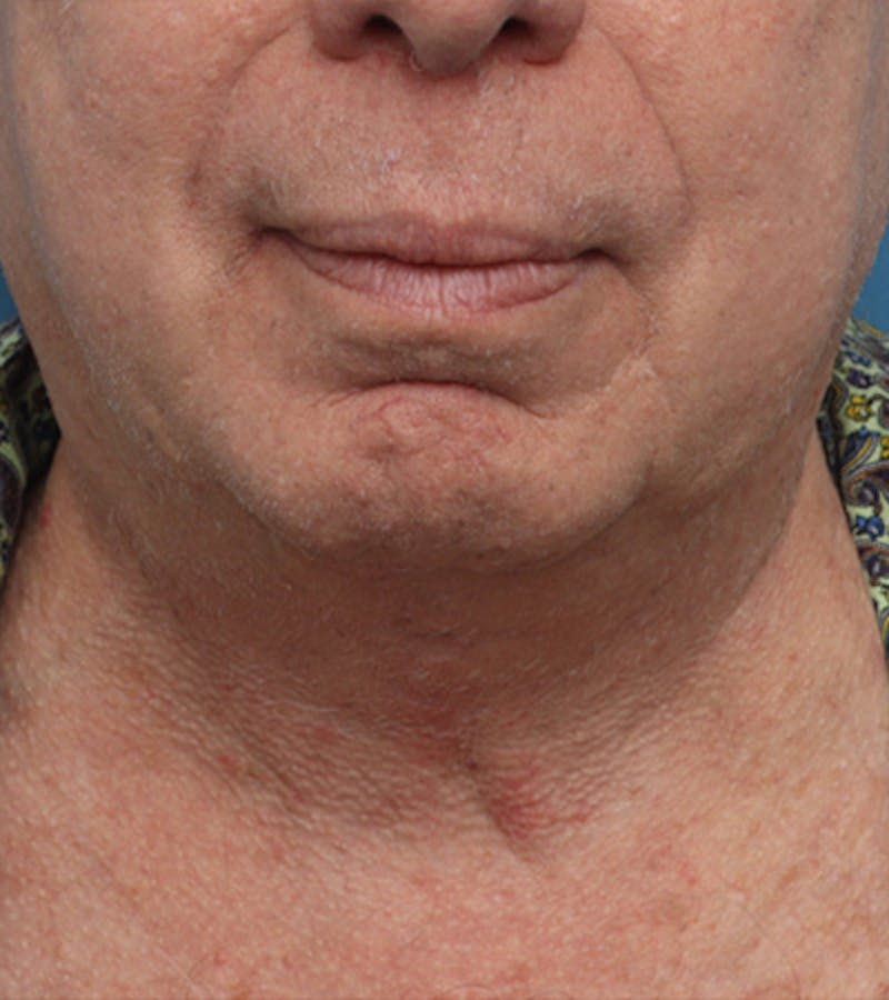 Facelift Before & After Gallery - Patient 324553 - Image 8