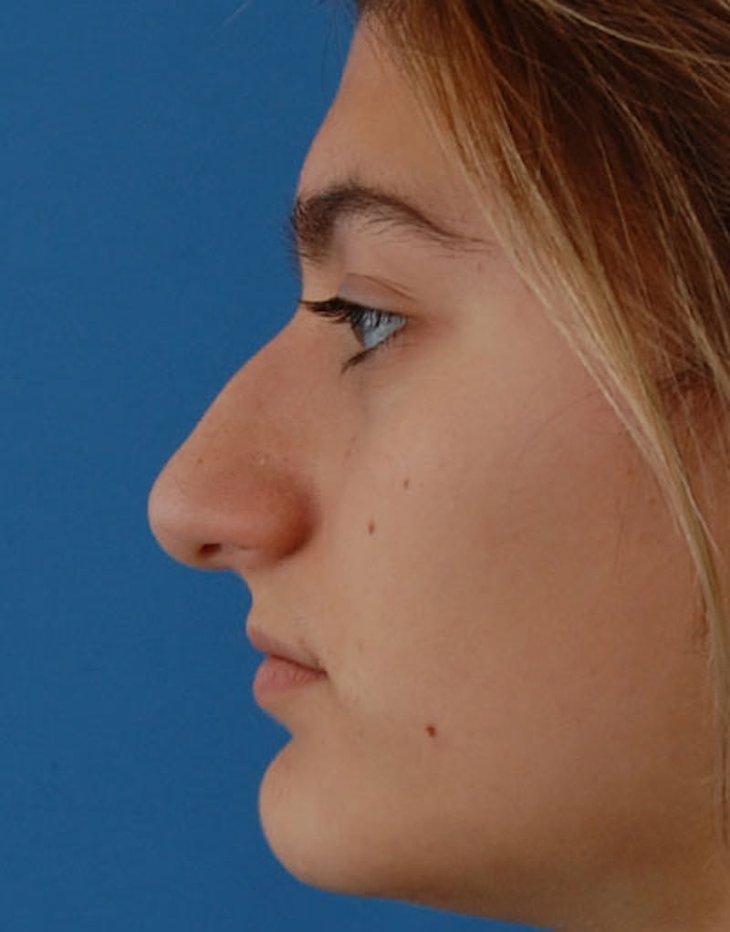 Rhinoplasty Before & After Gallery - Patient 641318 - Image 7