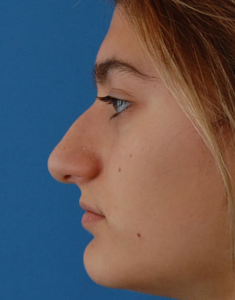 Rhinoplasty  Before & After Gallery - Patient 638251 - Image 7