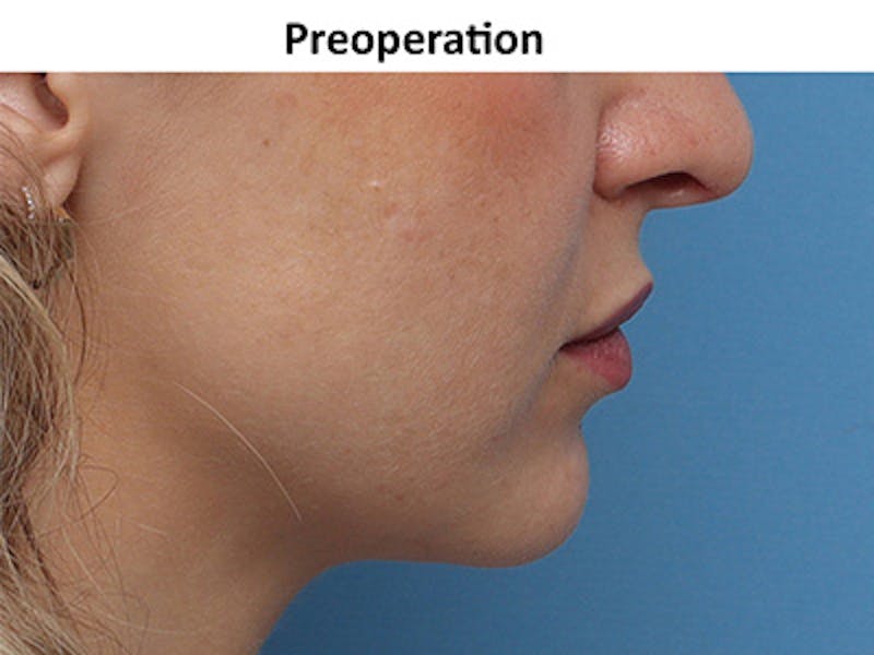 Chin Surgery Before & After Gallery - Patient 872425 - Image 1