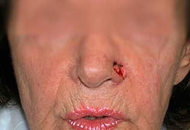 Facial Reconstruction Before & After Gallery - Patient 212999 - Image 1