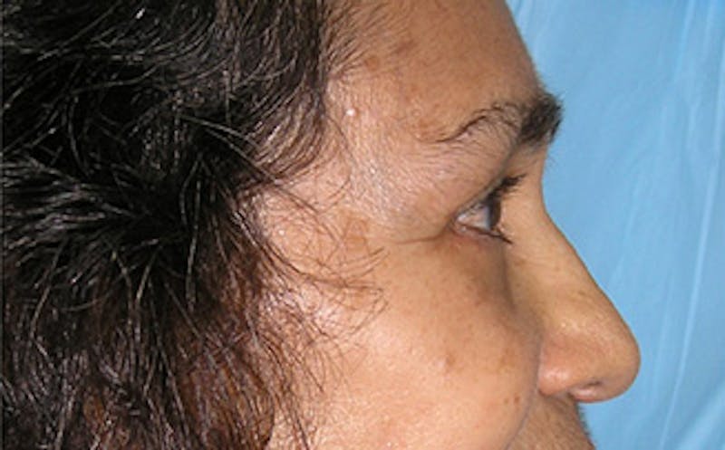 Brow Lift Before & After Gallery - Patient 115111 - Image 4