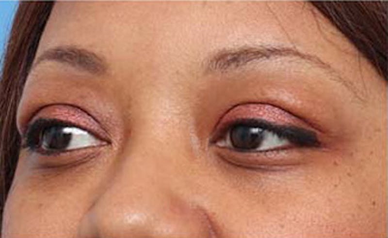 Eyelid Surgery Before & After Gallery - Patient 108834 - Image 5