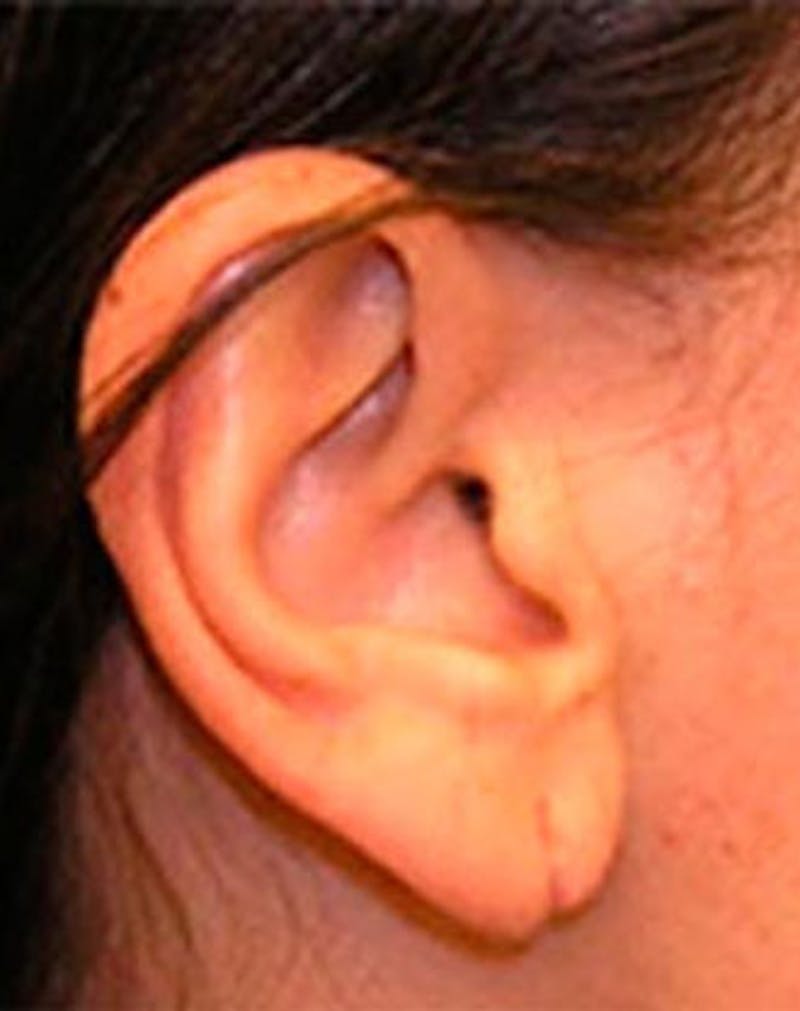 Patient UZH0Z_JHSnqzcghQUYnLwA - Earlobe Surgery Before & After Photos