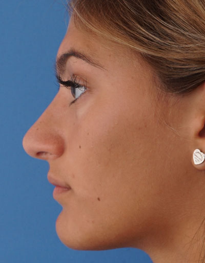 Rhinoplasty Before & After Gallery - Patient 641318 - Image 8