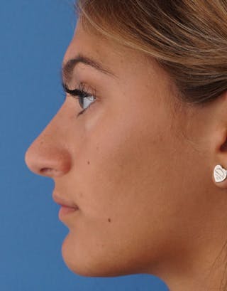 Rhinoplasty Before & After Gallery - Patient 638251 - Image 8