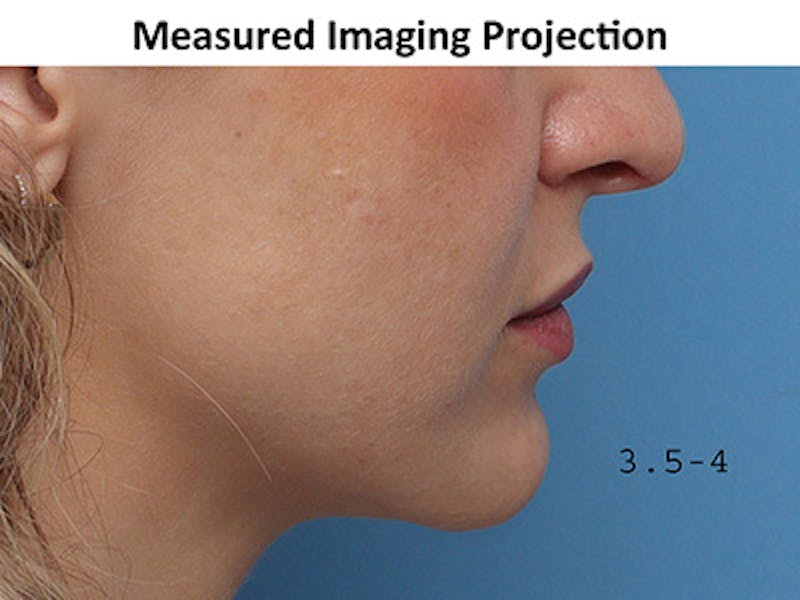 Chin Surgery Before & After Gallery - Patient 872425 - Image 4