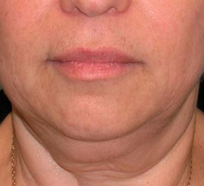 Facelift Before & After Gallery - Patient 107336 - Image 1