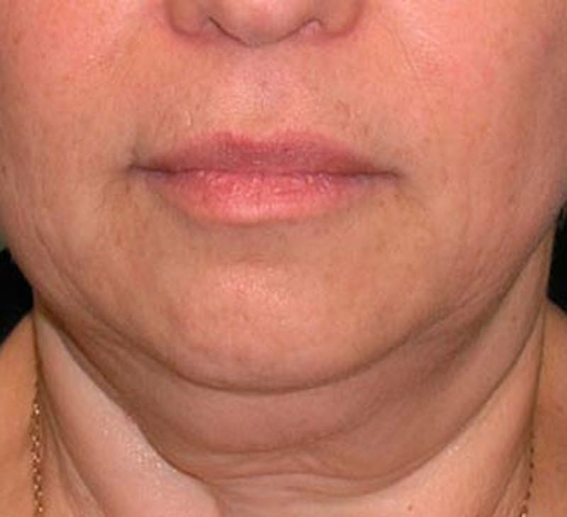 Patient MwQ1d2zIRKeLsRHOIzH08Q - Facelift Before & After Photos