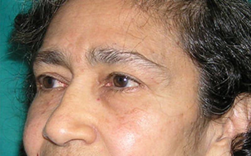 Brow Lift Before & After Gallery - Patient 115111 - Image 5