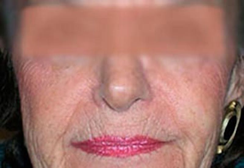 Facial Reconstruction Before & After Gallery - Patient 212999 - Image 2