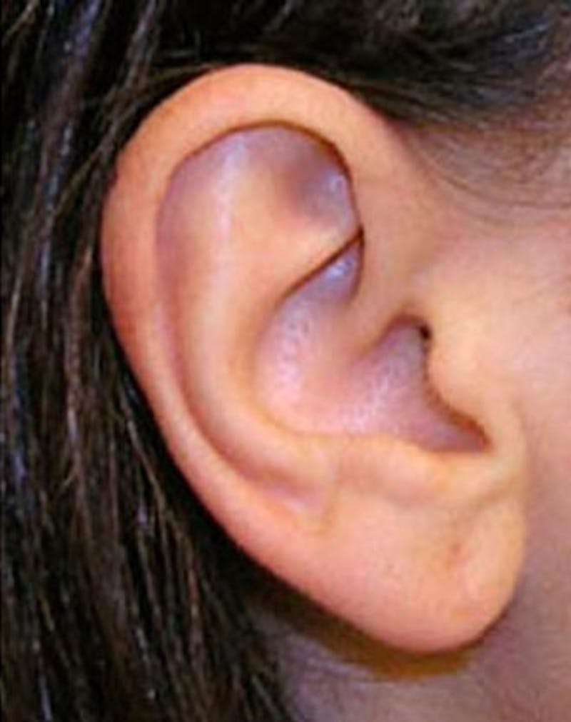 Ear Surgery Before & After Gallery - Patient 249464 - Image 2