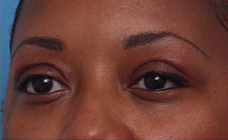 Eyelid Surgery Before & After Gallery - Patient 108834 - Image 6