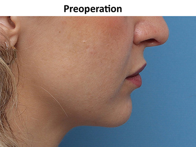 Patient 872425 | Chin Surgery Before & After Photos | Westreich