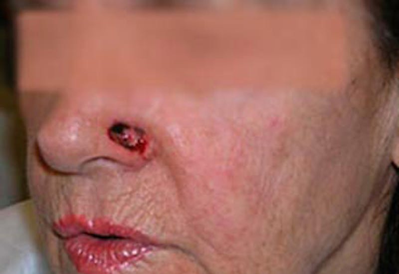Facial Reconstruction Before & After Gallery - Patient 212999 - Image 3