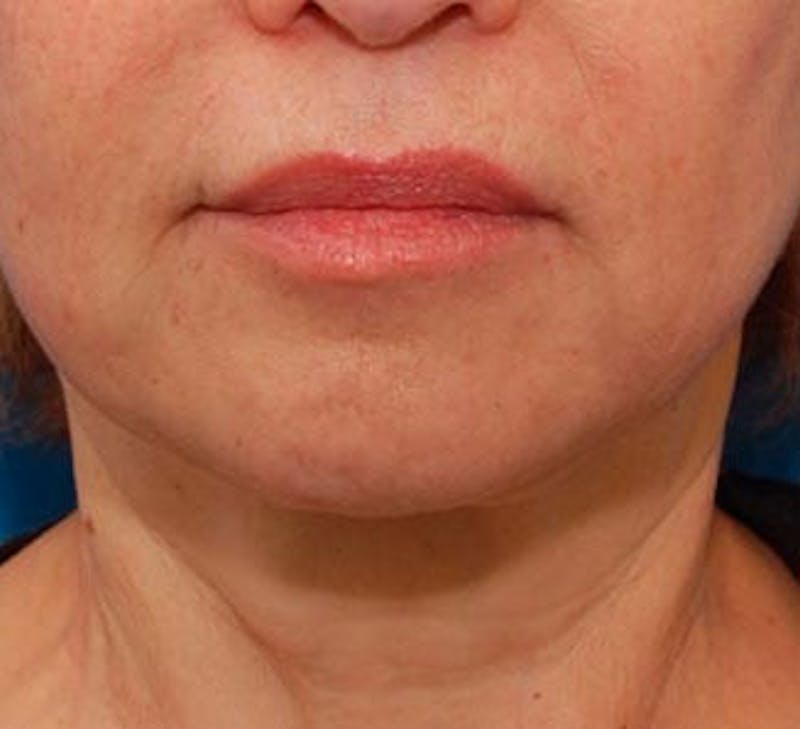 Facelift Before & After Gallery - Patient 107336 - Image 2