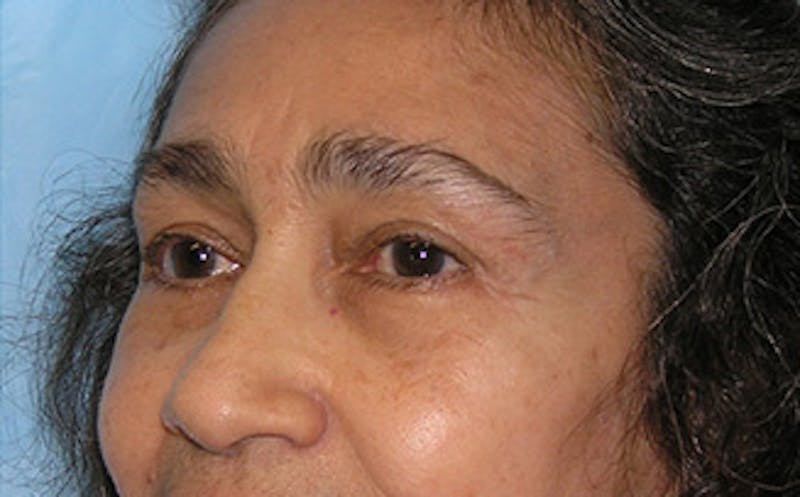 Brow Lift Before & After Gallery - Patient 115111 - Image 6