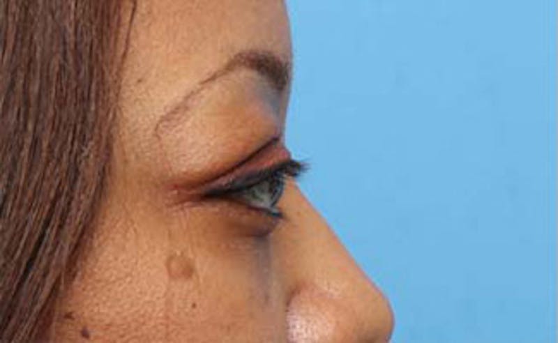 Eyelid Surgery Before & After Gallery - Patient 108834 - Image 7