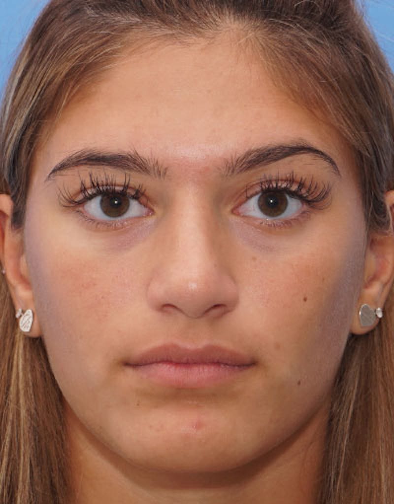 Rhinoplasty Before & After Gallery - Patient 641318 - Image 4