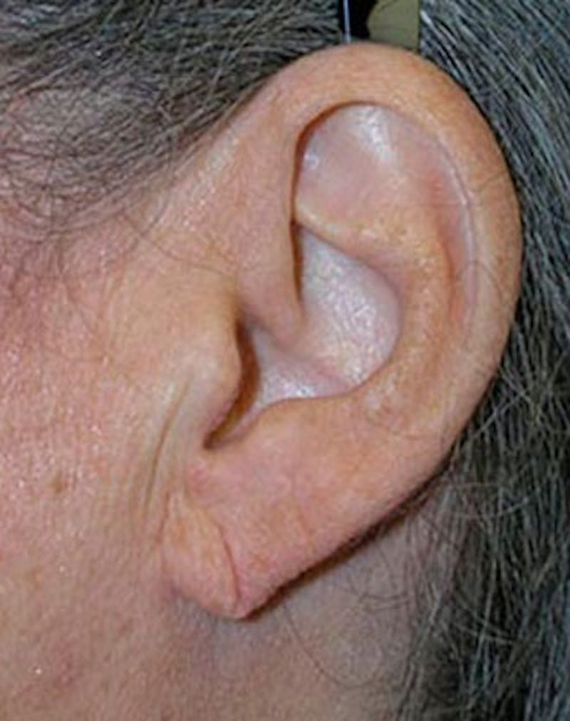 Patient DhQVCswoQsWRrQ1-TB4MjQ - Earlobe Surgery Before & After Photos