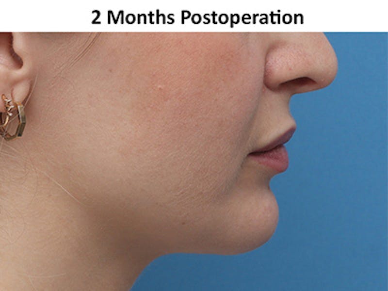 Chin Surgery Before & After Gallery - Patient 872425 - Image 2