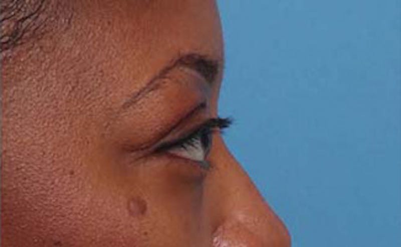 Eyelid Surgery Before & After Gallery - Patient 108834 - Image 8