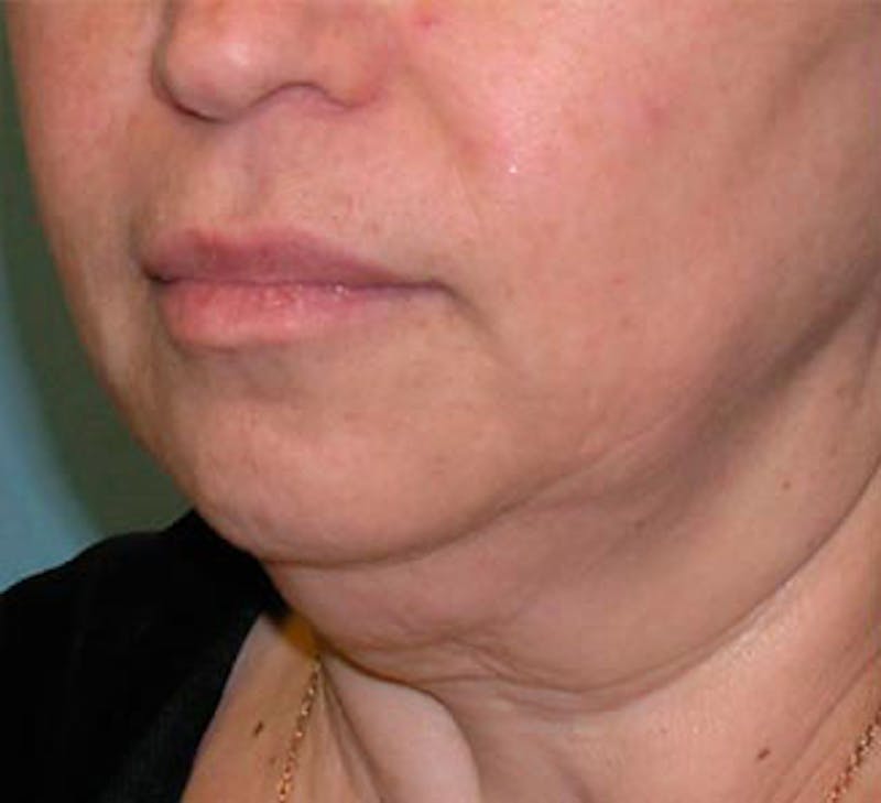 Facelift Before & After Gallery - Patient 107336 - Image 3