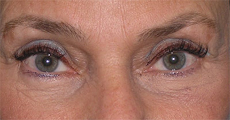 Brow Lift Before & After Gallery - Patient 105232 - Image 1