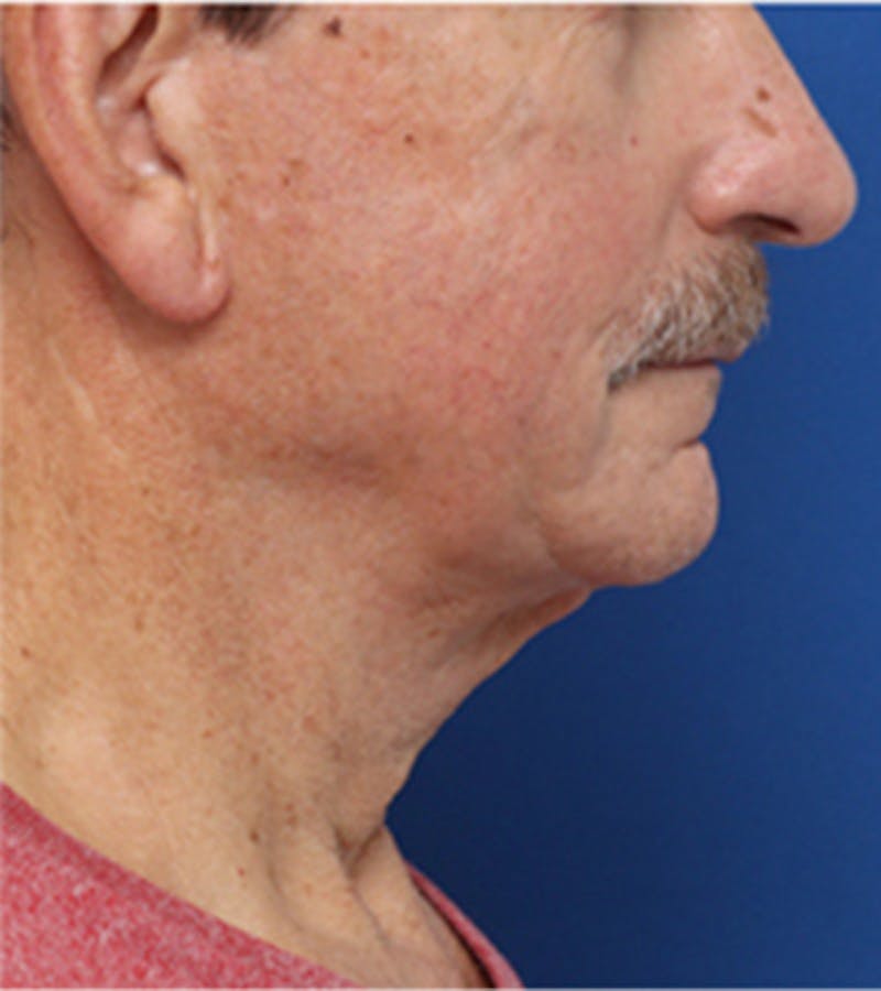 Jawline Contouring Before & After Gallery - Patient 381944 - Image 1