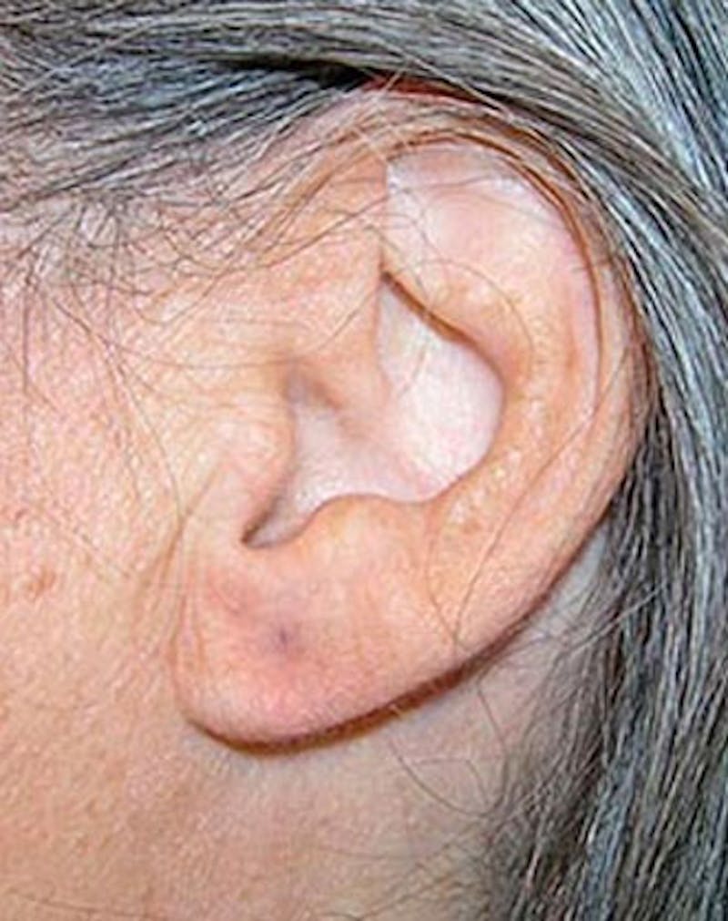 Ear Surgery Before & After Gallery - Patient 342388 - Image 2