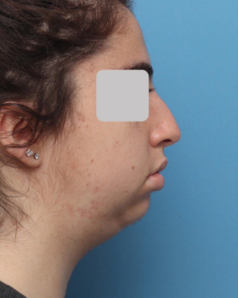 Patient MZhSsqkKTQiHTk2IbX1DTg - Chin Surgery Before & After Photos