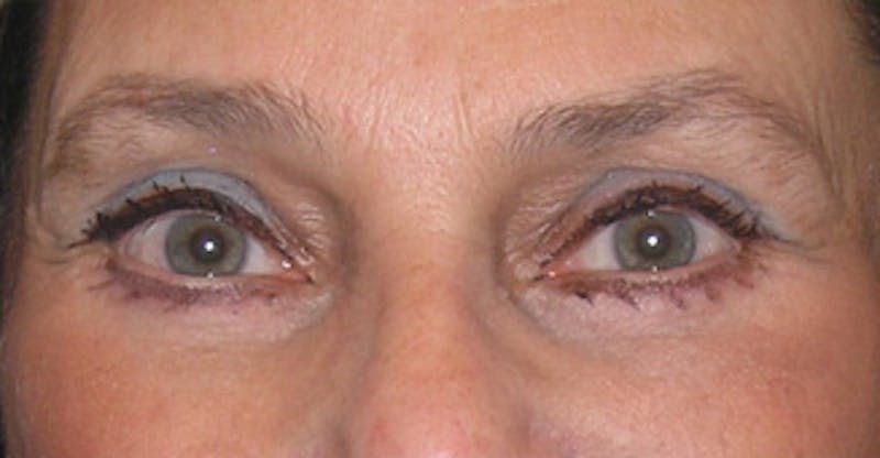 Brow Lift Before & After Gallery - Patient 105232 - Image 2